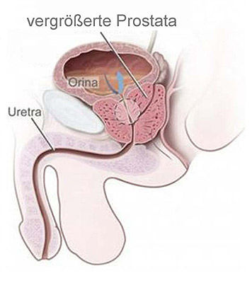 Laser versus Prostata