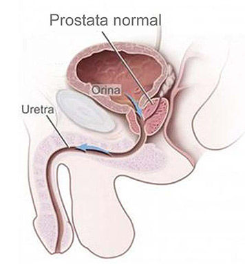 Laser versus Prostata